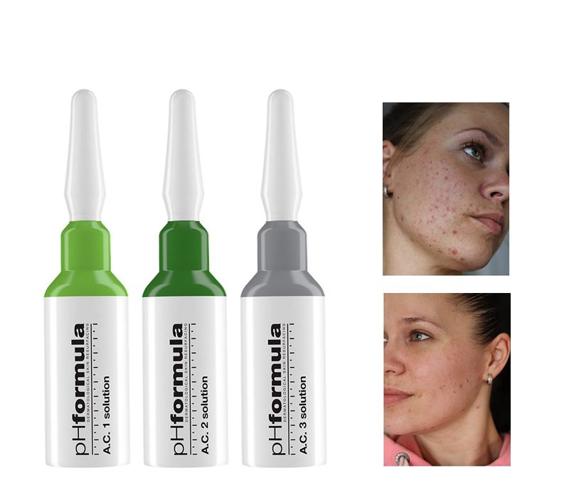 Acne treatment with Skin resurfacing