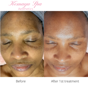 before and after hyperpigmentation treatment