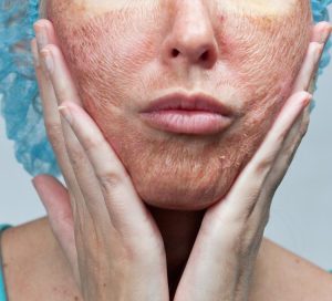 Skin Resurfacing vs Chemical Peel Hillcrest